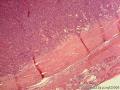 甲状腺包膜完整肿块，核分裂相多见，如何诊断？图5