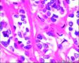 2014年第17期（总第96期）——子宫肌壁肿物图18