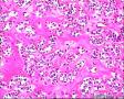 2014年第17期（总第96期）——子宫肌壁肿物图6