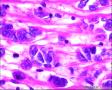2014年第17期（总第96期）——子宫肌壁肿物图14