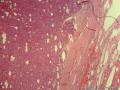甲状腺包膜完整肿块，核分裂相多见，如何诊断？图7
