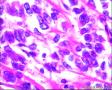 2014年第17期（总第96期）——子宫肌壁肿物图15
