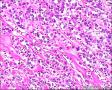 2014年第17期（总第96期）——子宫肌壁肿物图1