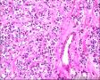 2014年第17期（总第96期）——子宫肌壁肿物图9