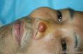鼻部皮疹（更新深切）图2
