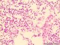 图片分享：（宫内膜）真菌感染图1
