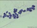 痰涂片，请问考虑什么癌细胞？图7