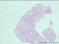 宫颈活检CIN3累腺？图4