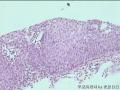 宫颈活检CIN3累腺？图13