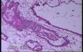左侧卵巢肿瘤(增加常规图片)图22