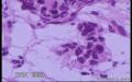 左侧卵巢肿瘤(增加常规图片)图46