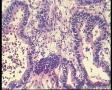 左侧卵巢肿瘤(增加常规图片)图20