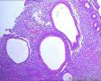 子宫内膜腺体这么多的核仁需要注意吗？间质细胞呢？图1