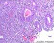 子宫内膜腺体这么多的核仁需要注意吗？间质细胞呢？图7
