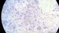 经典病例学习-睾丸混合性生殖细胞肿瘤图25