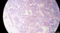 经典病例学习-睾丸混合性生殖细胞肿瘤图9