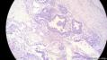 经典病例学习-睾丸混合性生殖细胞肿瘤图5