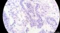 经典病例学习-睾丸混合性生殖细胞肿瘤图7