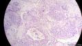 经典病例学习-睾丸混合性生殖细胞肿瘤图8