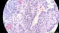 经典病例学习-睾丸混合性生殖细胞肿瘤图16