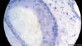 经典病例学习-睾丸混合性生殖细胞肿瘤图20