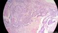 经典病例学习-睾丸混合性生殖细胞肿瘤图15