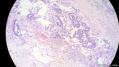 经典病例学习-睾丸混合性生殖细胞肿瘤图6