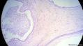 经典病例学习-睾丸混合性生殖细胞肿瘤图29