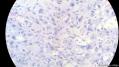 经典病例学习-睾丸混合性生殖细胞肿瘤图12