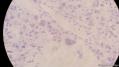 经典病例学习-睾丸混合性生殖细胞肿瘤图26