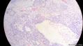 经典病例学习-睾丸混合性生殖细胞肿瘤图10