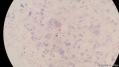 经典病例学习-睾丸混合性生殖细胞肿瘤图22