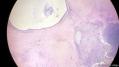 经典病例学习-睾丸混合性生殖细胞肿瘤图13