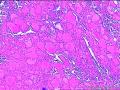 双侧甲状腺近全切标本，请老师看看怎么诊断图28