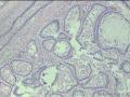 经典病例学习--成釉细胞瘤图17