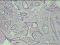 经典病例学习--成釉细胞瘤图1