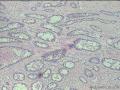 经典病例学习--成釉细胞瘤图7