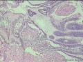 经典病例学习--成釉细胞瘤图10