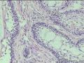 经典病例学习--成釉细胞瘤图12