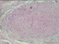 经典病例学习--成釉细胞瘤图2
