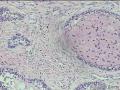 经典病例学习--成釉细胞瘤图14