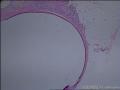 上肢肿物，可见多个直径0.1--0.3囊泡，褐色，请教诊断方向图4