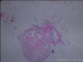上肢肿物，可见多个直径0.1--0.3囊泡，褐色，请教诊断方向图1