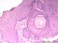 假上皮瘤样增生浸润部分可见角化珠吗？还是高分化鳞癌呢？图3