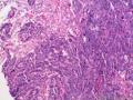大网膜肿瘤：恶性间皮瘤？乳头状腺癌？图8