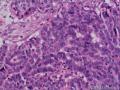 大网膜肿瘤：恶性间皮瘤？乳头状腺癌？图9
