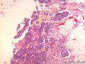 大网膜肿瘤：恶性间皮瘤？乳头状腺癌？图3
