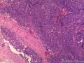 大网膜肿瘤：恶性间皮瘤？乳头状腺癌？图2