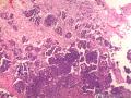 大网膜肿瘤：恶性间皮瘤？乳头状腺癌？图1
