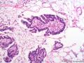 大网膜肿瘤：恶性间皮瘤？乳头状腺癌？图7